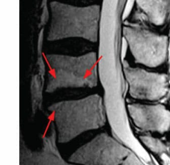 Pincement discal : quels sont les traitements possibles ?